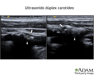 Ultrasonido dúplex carotídeo