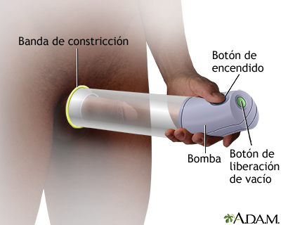 Dispositivos de vacío para problemas de erección