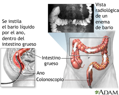 Enema de bario