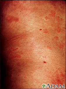 Ronchas (urticaria) en el tronco