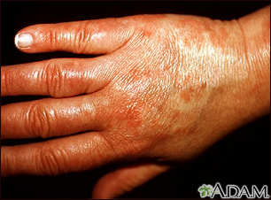 Vasculitis - urticarial en la mano