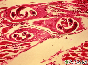 Trichinella spiralis en el músculo humano