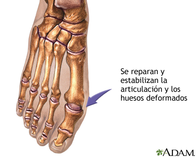 Procedimiento (segunda parte)