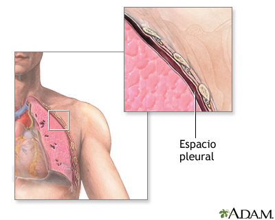 Inserción de una sonda torácica - Serie - Cavidad pleural