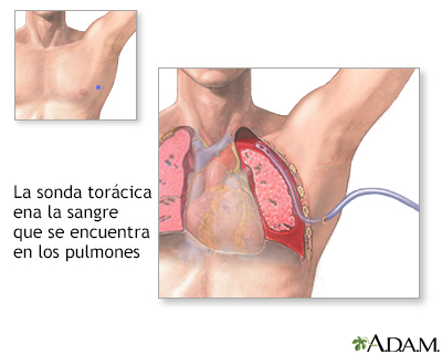 Inserción de una sonda torácica