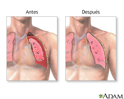 Antes y después de la inserción del tubo torácico