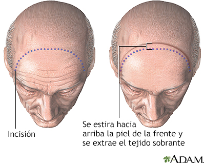 Procedimiento