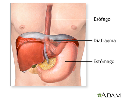 Reparación quirúrgica de una hernia hiatal - serie