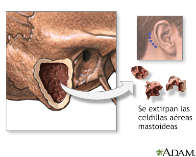 Mastoidectomía - Procedimiento