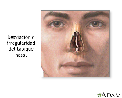 Indicaciones - Desviación septal