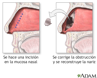 Procedimiento - Septoplastia