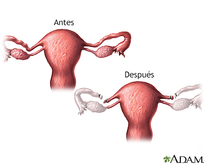 Antes y después de la ligadura de trompas