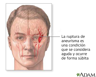 Ruptura de aneurisma intracraneal