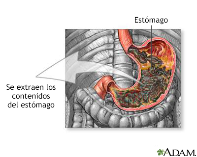 Succión gástrica