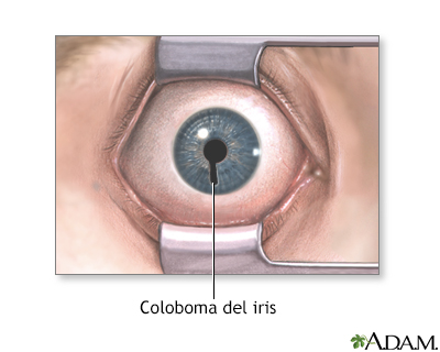 Coloboma del iris