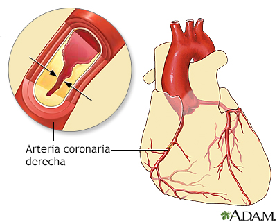 Enfermedad de las arterias coronarias