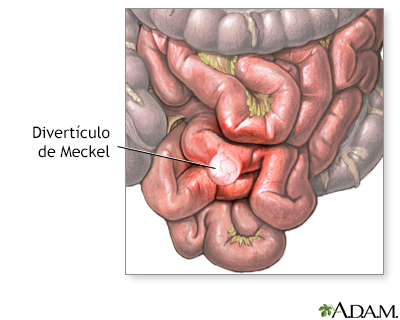 Divertículo de Meckel