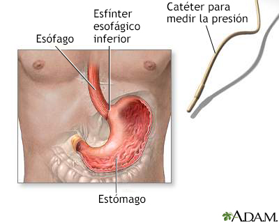 Manometría esofágica