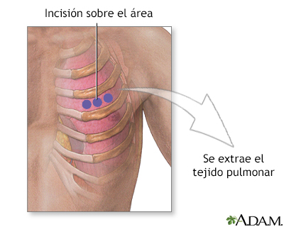 Incisión para biopsia de pulmón