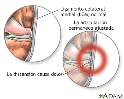 Dolor del ligamento medial colateral