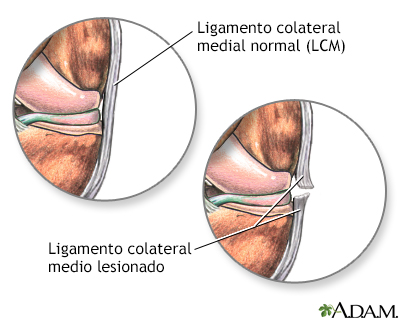 Ligamento medial colateral desgarrado