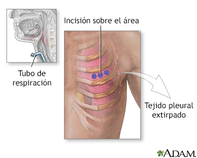 Incisión para biopsia de tejido pleural