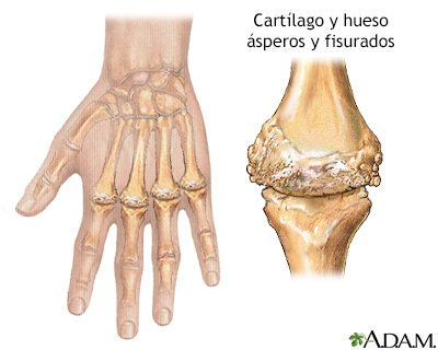 Artritis reumatoide