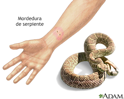 Mordedura de serpiente