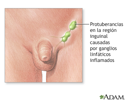 Ganglios linfáticos inflamados en la ingle