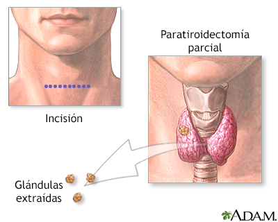 Paratiroidectomía