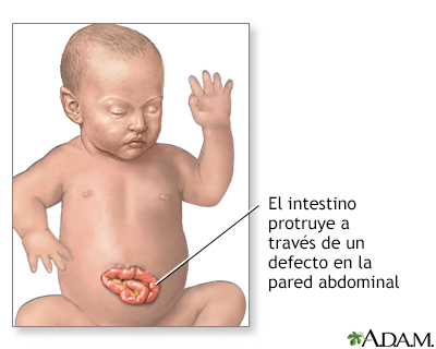 Hernia abdominal infantil (gastrosquisis)