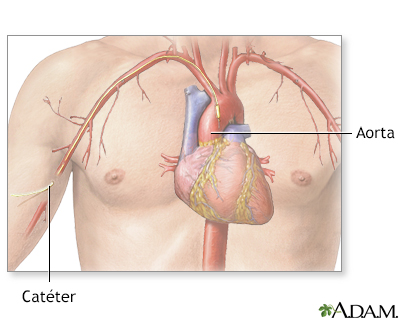 Arteriograma cardíaco