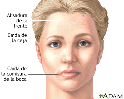 Caída facial