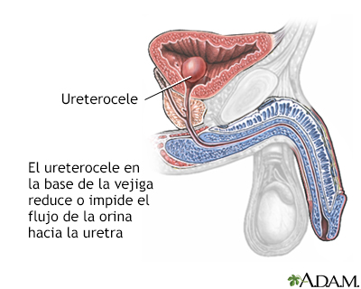 Ureterocele