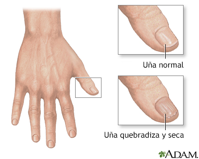 Uñas quebradizas