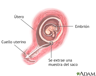 Muestra de vellosidad coriónica