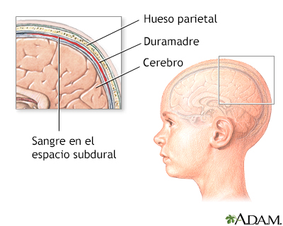 Incremento de presión intracraneal