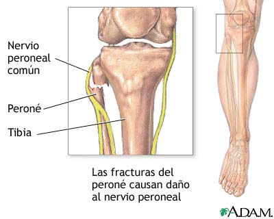 Disfunción del nervio peroneo común