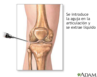 Aspiración de las articulaciones