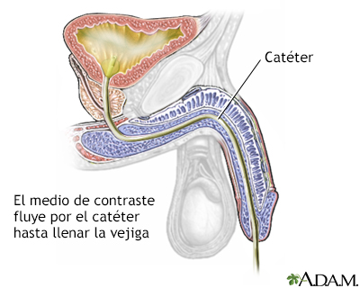 Cistografía