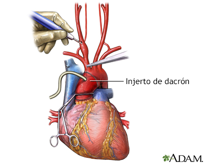 Colocación de injerto protésico