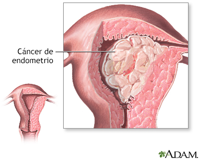 Cáncer endometrial