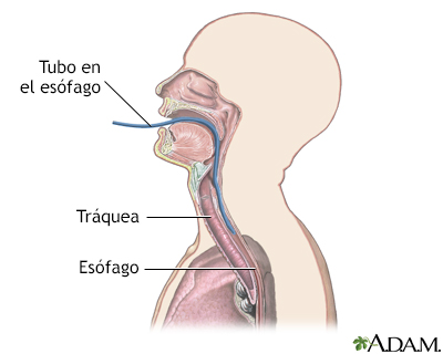 Monitorización del pH esofágico