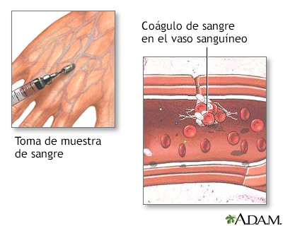 Coágulos sanguíneos