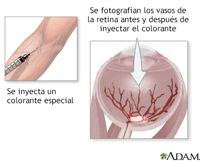 Inyección de colorante en la retina