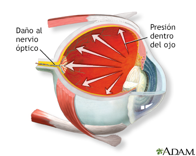 Glaucoma