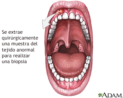 Biopsia de las encías