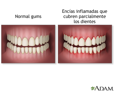 Encías inflamadas