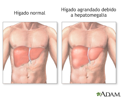 Hepatomegalia