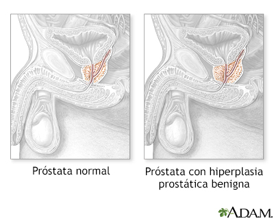 Hiperplasia